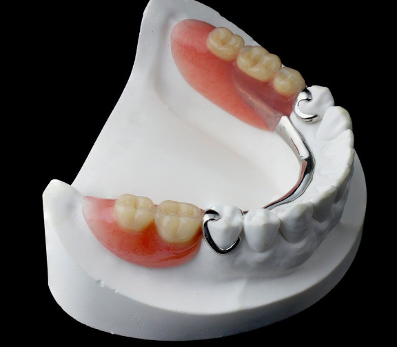 Протезирование 1 зуба или нескольких зубов зубного ряда