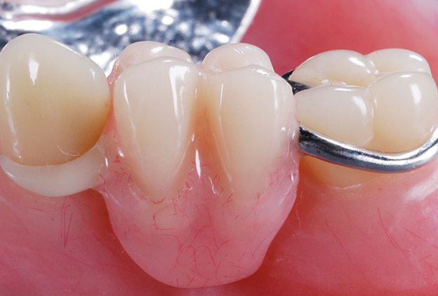 Съемное протезирование зубов: преимущества и недостатки
