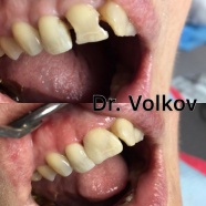Реставрация 11 зуба