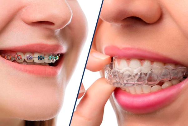 Методы выравнивания зубов в современной стоматологии 