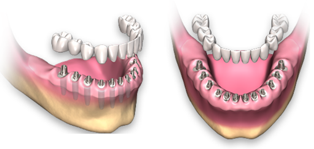 Полная имплантация зубов в стоматологическом центре «Эстетикс» - все преимущества процедуры