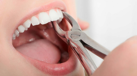 Удаленные зубы и импланты: тонкости мастерства