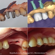 Имплантация 2 зубов