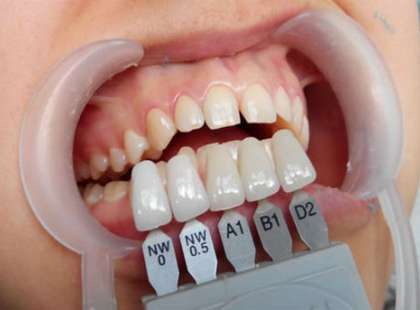 Что такое вкладка при протезировании зубов?