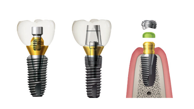 Корейские импланты зубов: особенности, цены и отзывы пациентов 