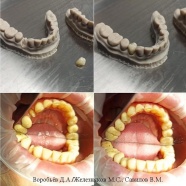 Восстановление зуба 44 цельноцирконевой коронкой "Prettau" с применением дентального сканера и технологий CAD/CAM.