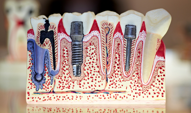 Стоимость зубного импланта и факторы её формирования