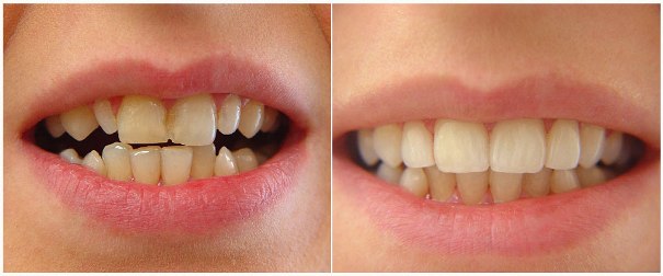 Виниры на кривые зубы и в исправлении неправильного прикуса