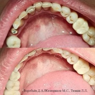 Коронки из диоксид циркония на зуб, и ранее установленные коронки на имплантатах