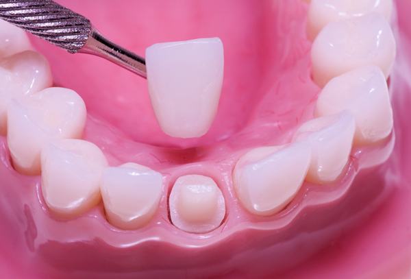 Протезирование зубов: какие протезы лучше