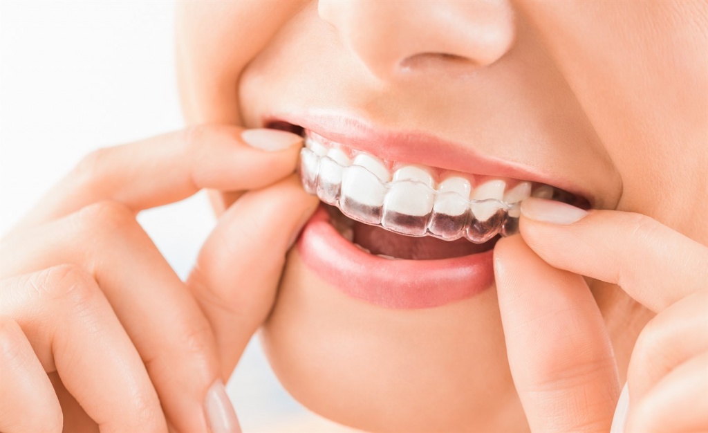 Каппы Инвизилайн в лечении неправильного прикуса и выравнивания зубов