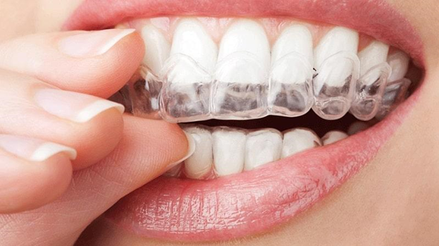 Ремотерапия зубов – эффективный метод восстановления зубной эмали