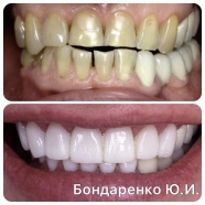 Дизайн улыбки, изменение формы, цвета зубов с помощью керамических виниров e.max.