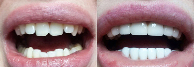 Металлические зубные коронки с напылением, особенности