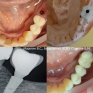 Металлокерамическая коронка на имплантате в области 3.6 зуба. Винтовая фиксация