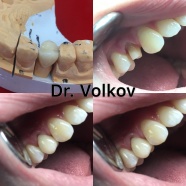 Протезирование зуба 1.4 циркониевой вкладкой и циркониевой коронкой