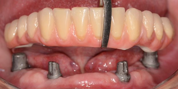 Зубные протезы на имплантах: способы установки, преимущества метода
