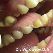 Восстановление зуба культовой вкладкой и коронкой, диоксид циркония