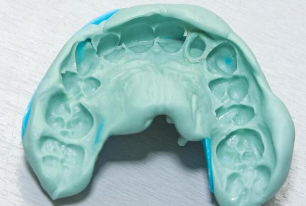 Зачем нужны слепки зубов для протезирования, из каких материалов их создают 