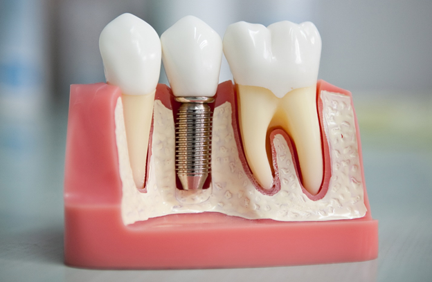 Различные виды имплантации зубов и их особенности 