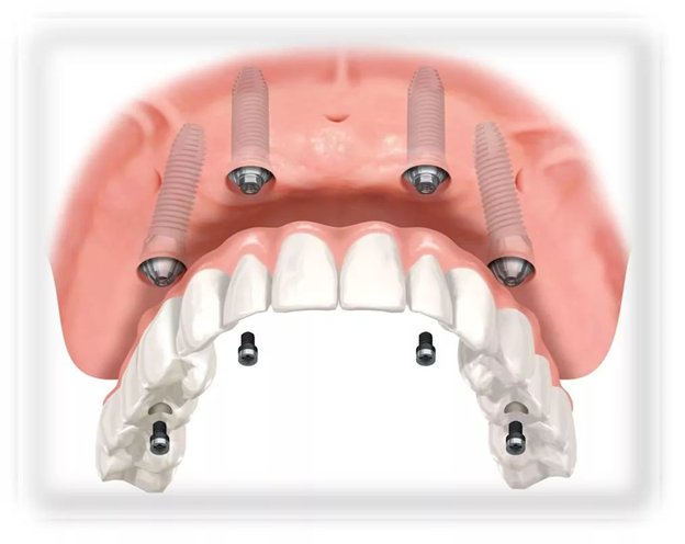 Импланты на верхнюю челюсть и их особенности