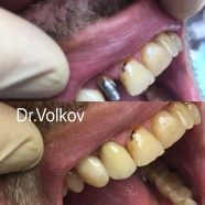 Протезирование 12 зуба металлокерамической коронкой