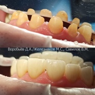 Зубопротезирование цельцирконевыми коронками Prettau во фронтальной группе зубов с помощью детального сканера и CAD/CAM технологии.