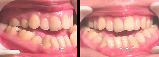 Ортодонтия и хирургия в лечении аномалии зубов 