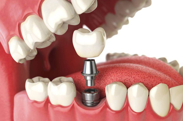 Почему выпал имплант зуба – основные причины и как не допустить осложнений