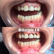 Гингивопластика в области 1.2;2.1;2.2 зубов.