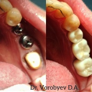 Коронки из диоксида циркония по CAD/CAM технологии на зубе и имплантатах. Техники: Железняков, Тюмин