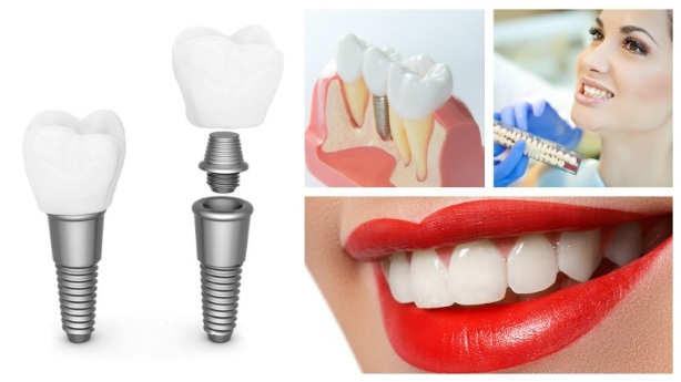 Особенности и преимущества экспресс-имплантации после удаления зуба 