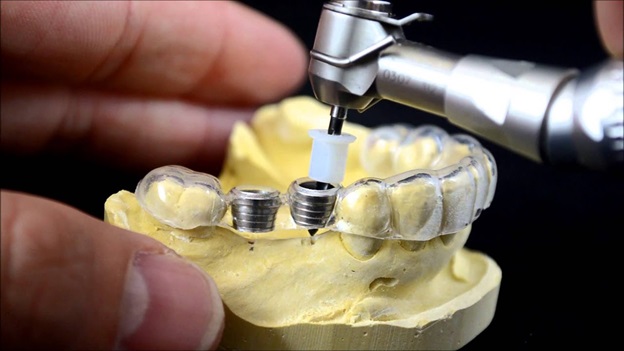 Что такое хирургический шаблон для имплантации зубов и какая от него польза?