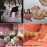 Цельцирконивая коронка на 46 зуб. Цифровой метод, без использования оттиска (слепка) зубов.