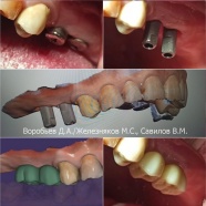 Установка циркониевых коронок на имплантатах с помощью цифровых технологий CAD/CAM. Без применения оттиска (слепка) зубов.