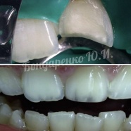 Реставрация композитным материалом перелома коронки зуба 2.1 вследствие травмы.