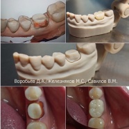 Цельцирконивая коронка Multilayer 36 зуб. Цифровой метод, без использования оттиска (слепка) зубов.
