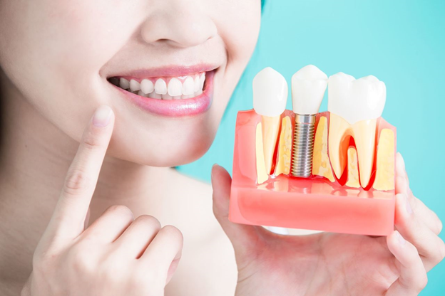 Минусы зубных имплантов – вся правда о процедуре