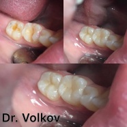 Реставрация зубов 4.6 и 4.7