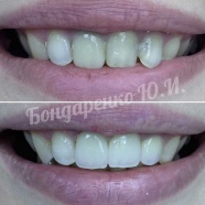 Керамические виниры e.max на 1.1 и 2.1 зубах и коронка e.max на 2.2 зубе с изменением формы