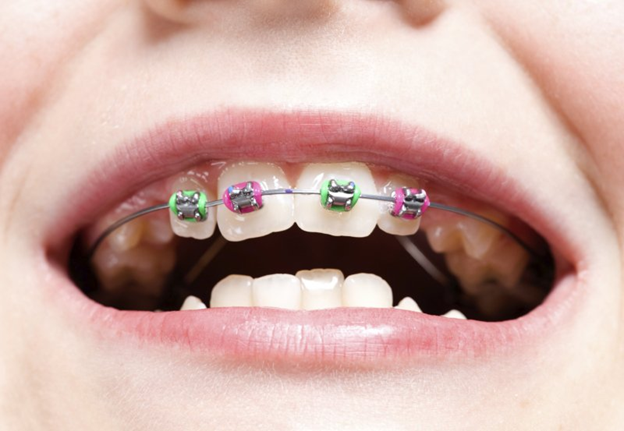 Что такое детская ортодонтия?