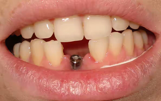 В какие сроки устанавливается имплант после удаления зуба?