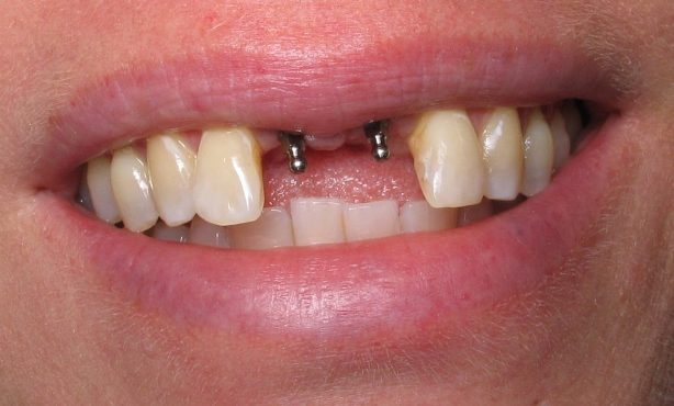 Методы и особенности имплантации зубов верхней челюсти, какие импланты подходят
