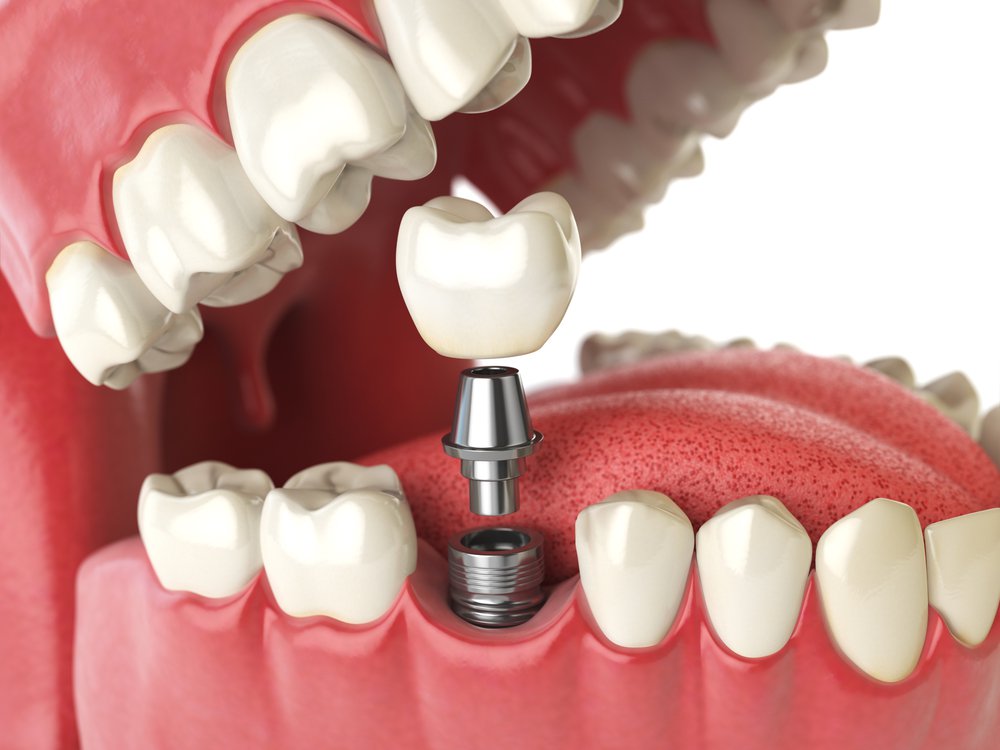 Зубной мост на имплантах как альтернатива протезированию