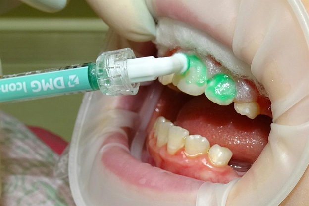 Лечение кариеса ICON Томск Нагорная стоматология по рейтингу томск